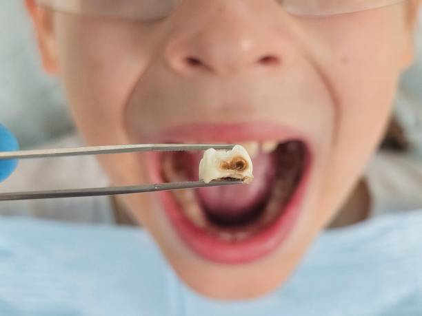 Best Knocked-Out Tooth (Avulsed Tooth) Treatment in St Martins, MO